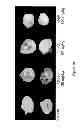 Fig. 15 - Compounds and Methods for Treating Cancer and Diseases of the Central Nervous System