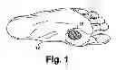 Fig. 02 - Angiogenesis initiation and growth