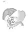 Fig. 32 - Treatment method