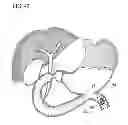 Fig. 40 - Treatment method