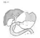 Fig. 43 - Treatment method
