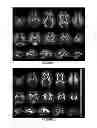 Fig. 02 - METHOD FOR IDENTIFYING NEUROPROTECTIVE COMPOUNDS AND/OR NEUROREGENERATION STIMULATORS BY FRACTIONAL ANISOTROPY MEASUREMENTS BY DIFFUSION-BASED MRI SCANNING