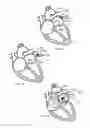 Fig. 02 - Method and Systems for Delivering and Deploying a Sensory Implant In Situ
