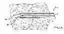 Fig. 16 - Methods and devices for removing tissue from a patient