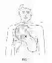 Fig. 02 - Cardiac resuscitation with prompting and defibrillation in separate units and with an activity sensor for detecting patient initiated movement