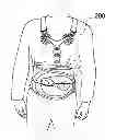 Fig. 01 - Thoracic lumbar sacral orthosis