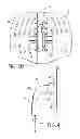 Fig. 04 - Thoracic lumbar sacral orthosis