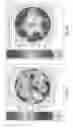 Fig. 09 - EYE COVERINGS FOR CORNEAL HEALING AND METHODS OF USE