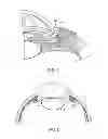 Fig. 02 - Delivery system for ocular implant
