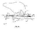 Fig. 04 - Recovery catheter assembly