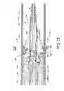 Fig. 23 - Direct stream hydrodynamic catheter system