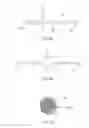 Fig. 05 - Repositionable therapy delivery element anchor