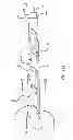 Fig. 12 - Devices and methods for perfusion therapy