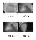 Fig. 03 - Shielded intraocular probe for improved illumination or therapeutic application of light
