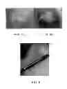 Fig. 04 - Shielded intraocular probe for improved illumination or therapeutic application of light