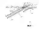 Fig. 04 - Methods and apparatus for introducing tumescent fluid to body tissue