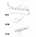 Fig. 17 - Methods and apparatus for introducing tumescent fluid to body tissue
