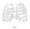 Fig. 22 - Systems and methods for sternum repair