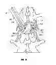 Fig. 09 - Surgical cutting tool
