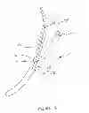 Fig. 07 - Methods and devices for performing gastroplasty