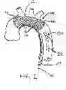 Fig. 02 - Embolic protection device