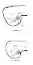 Fig. 02 - BRIDGE BUTTON FOR LIGAMENT RECONSTRUCTION