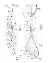 Fig. 02 - Suture assembly with suture load distribution