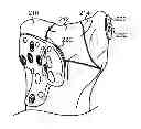 Fig. 01 - ATRAUMATIC FASTENER AND BONE STABILIZATION SYSTEM AND METHOD OF USE