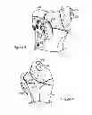 Fig. 03 - ATRAUMATIC FASTENER AND BONE STABILIZATION SYSTEM AND METHOD OF USE