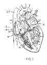 Fig. 02 - Optical fiber-fine wire lead for electrostimulation and sensing
