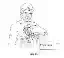 Fig. 03 - LEADLESS CARDIAC STIMULATION SYSTEMS