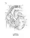 Fig. 16 - LEADLESS CARDIAC STIMULATION SYSTEMS
