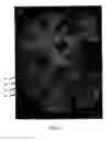Fig. 04 - Method of treating depression, mood disorders and anxiety disorders using neuromodulation