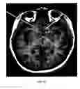 Fig. 08 - Method of treating depression, mood disorders and anxiety disorders using neuromodulation
