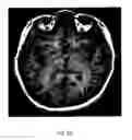 Fig. 09 - Method of treating depression, mood disorders and anxiety disorders using neuromodulation