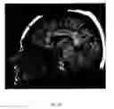 Fig. 10 - Method of treating depression, mood disorders and anxiety disorders using neuromodulation