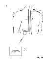 Fig. 02 - Dorsal column stimulation therapy