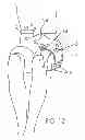 Fig. 11 - Flexible, wearable therapeutic laser array