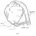 Fig. 02 - METHOD AND APPARATUS FOR EFFECTING AN AORTIC VALVE BYPASS, INCLUDING THE PROVISION AND USE OF A T-STENT FOR EFFECTING A DISTAL ANASTOMOSIS FOR THE SAME