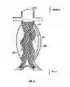 Fig. 06 - Devices and methods for treatment of abdominal aortic aneurysm