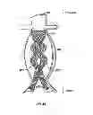 Fig. 09 - Devices and methods for treatment of abdominal aortic aneurysm