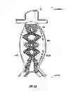 Fig. 10 - Devices and methods for treatment of abdominal aortic aneurysm