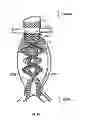 Fig. 12 - Devices and methods for treatment of abdominal aortic aneurysm