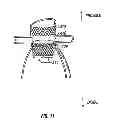 Fig. 13 - Devices and methods for treatment of abdominal aortic aneurysm