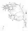 Fig. 02 - Total artificial heart