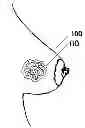 Fig. 01 - METHOD OF UTILIZING AN IMPLANT IN A HUMAN BREAST