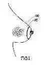Fig. 02 - METHOD OF UTILIZING AN IMPLANT IN A HUMAN BREAST
