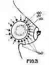 Fig. 04 - METHOD OF UTILIZING AN IMPLANT IN A HUMAN BREAST