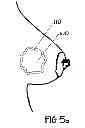 Fig. 06 - METHOD OF UTILIZING AN IMPLANT IN A HUMAN BREAST