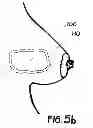 Fig. 07 - METHOD OF UTILIZING AN IMPLANT IN A HUMAN BREAST